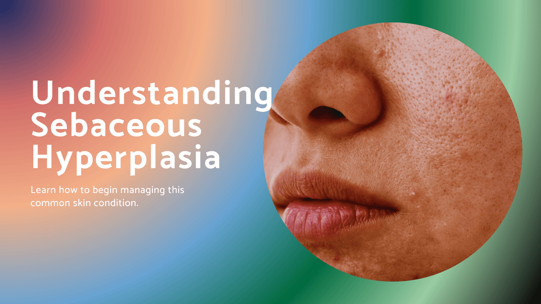 Sebaceous Hyperplasia: Understanding and Managing